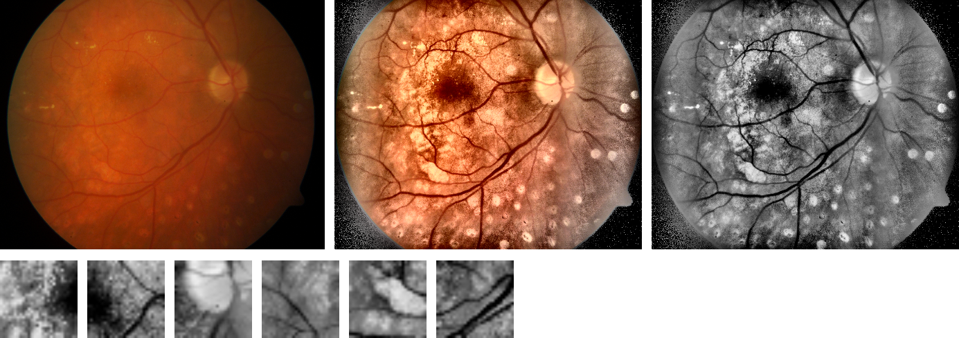 Left: original fundus photograph with diabetic retinopathy. Middle: after border cropping and adaptive contrast enhancement. Right: the green channel the network trains on. Bottom row: six 28×28 lesion-centered patches.